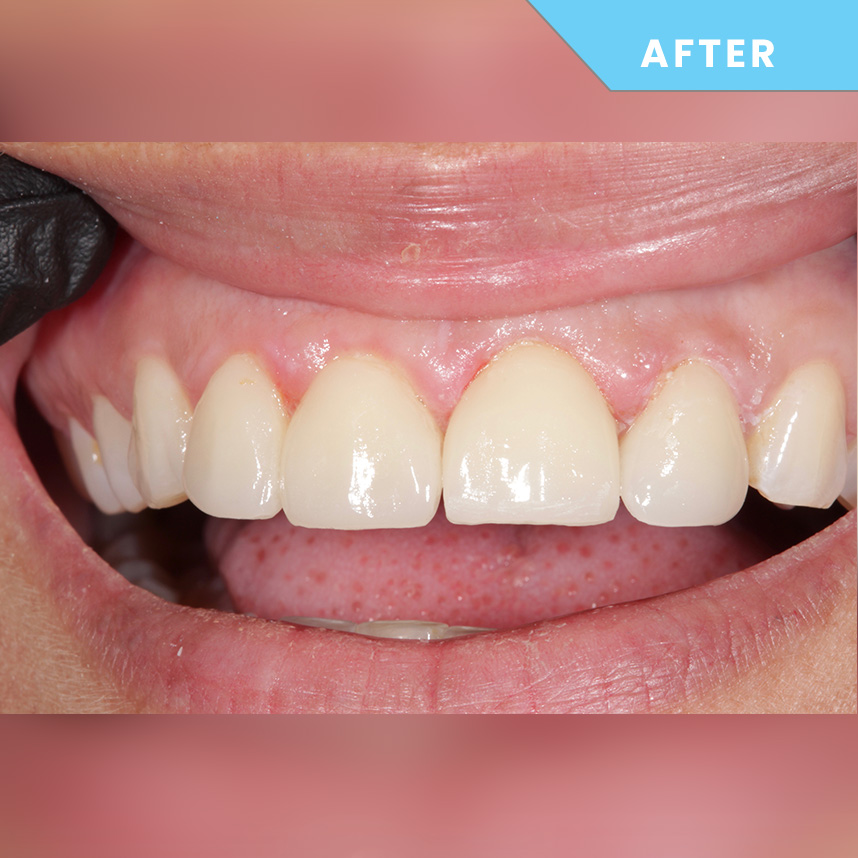 After treatment 1