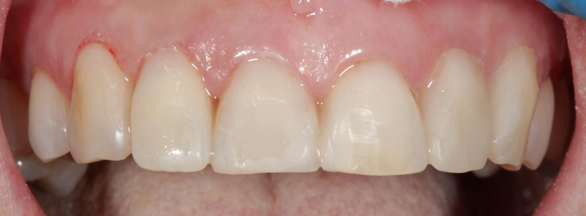 After treatment – Case 10