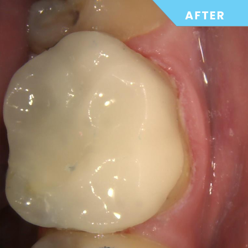 After treatment – Case 04