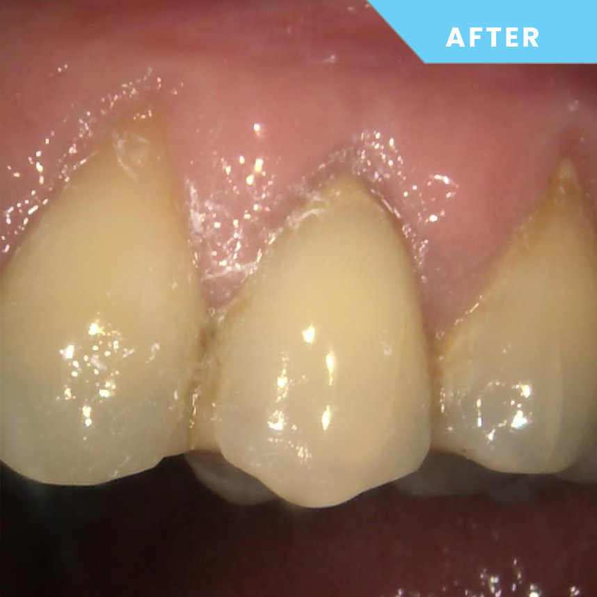 After treatment – Case 05