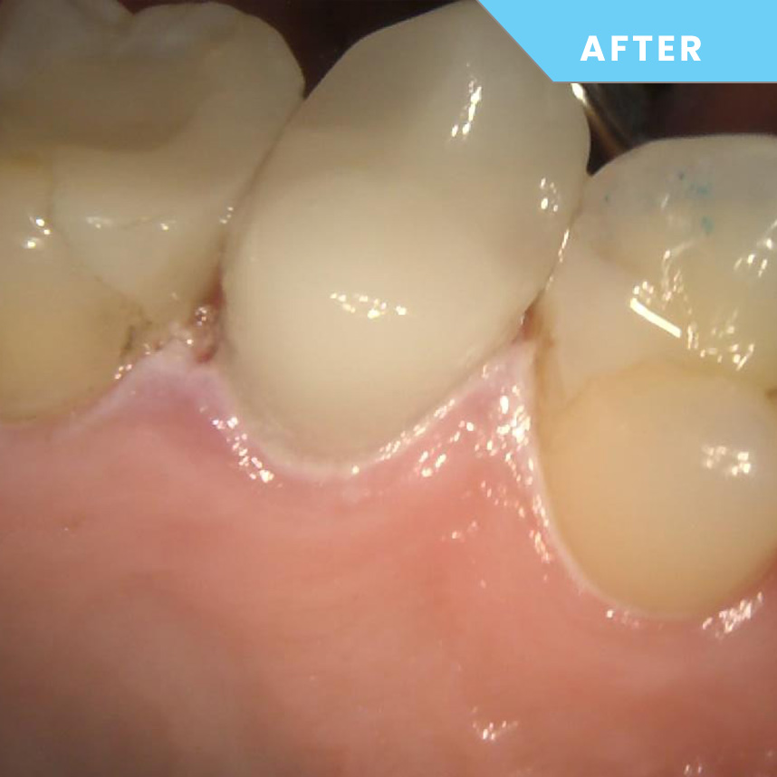 After treatment – Case 06