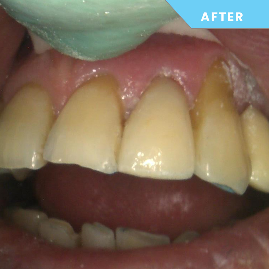 After treatment – Case 07