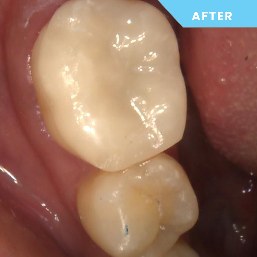 After treatment – Case 08