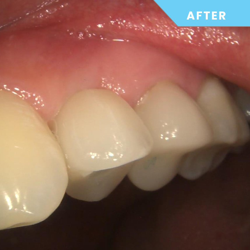 After treatment – Case 09