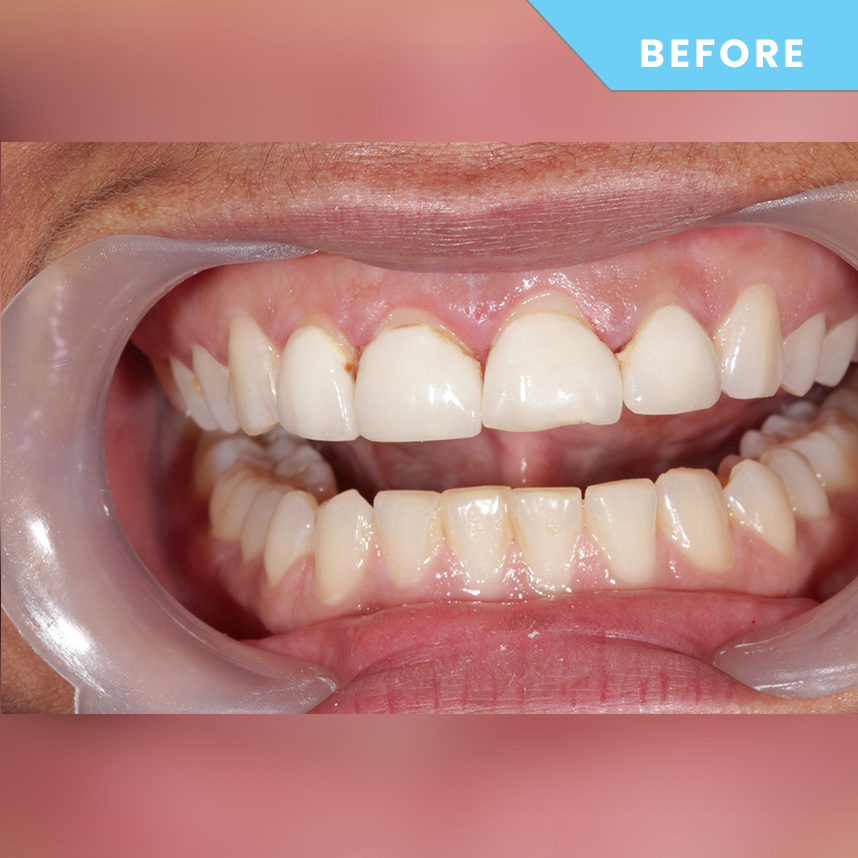 Before treatment 1