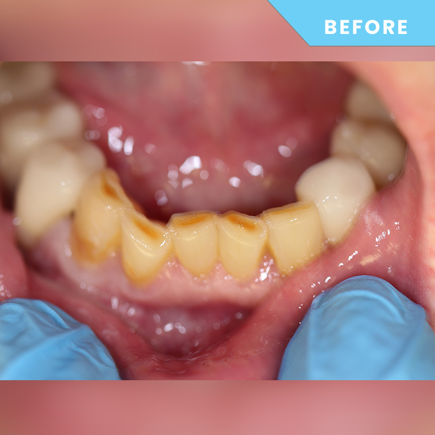Before treatment 2