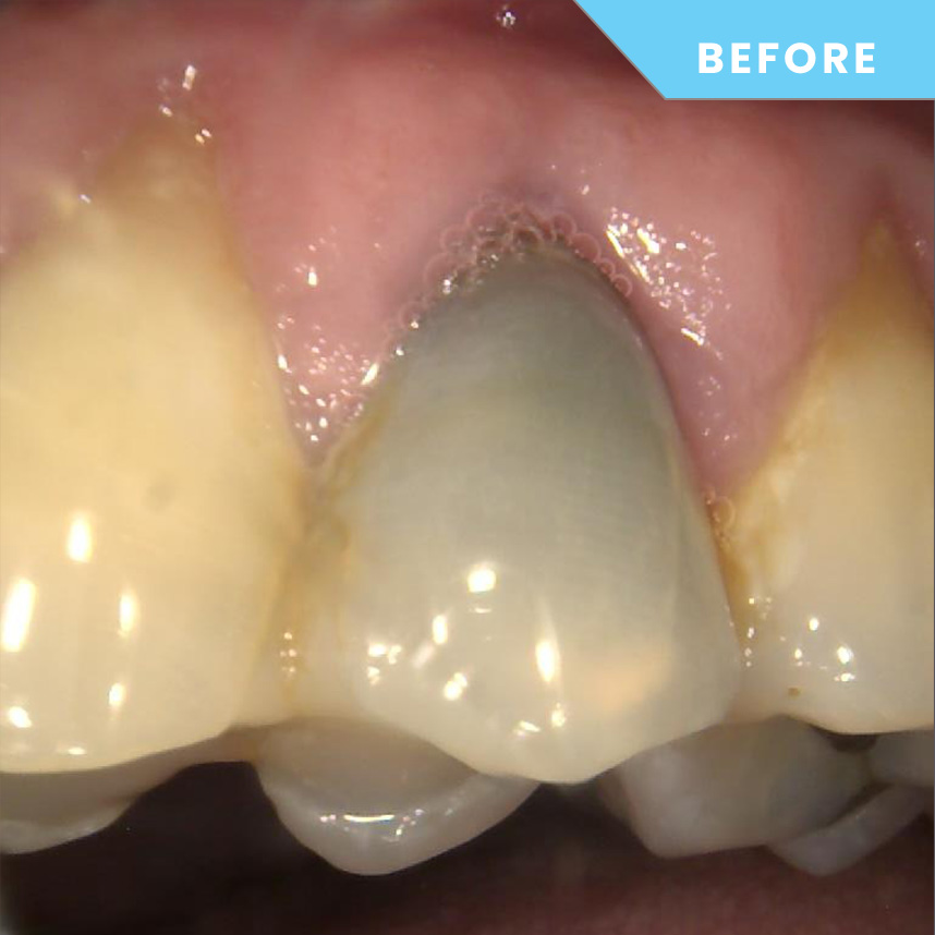 Before treatment – Case 05