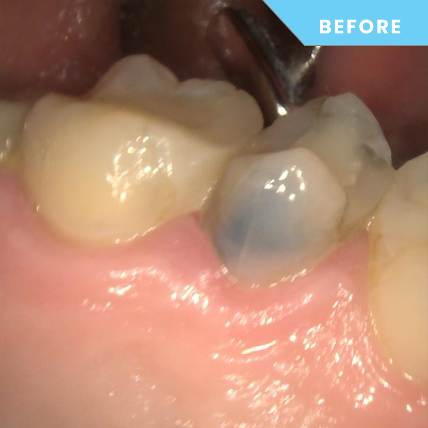 Before treatment – Case 06