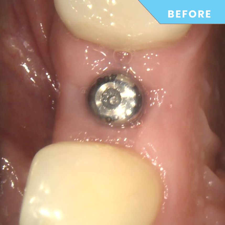 During treatment – Case 09