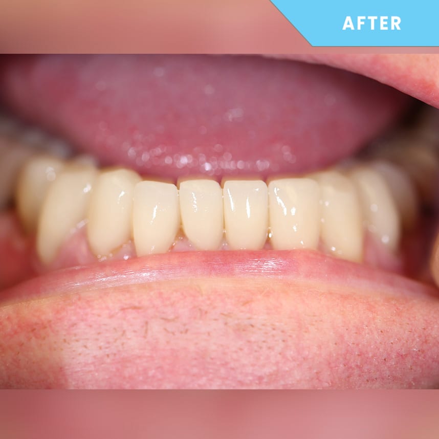 After treatment 2
