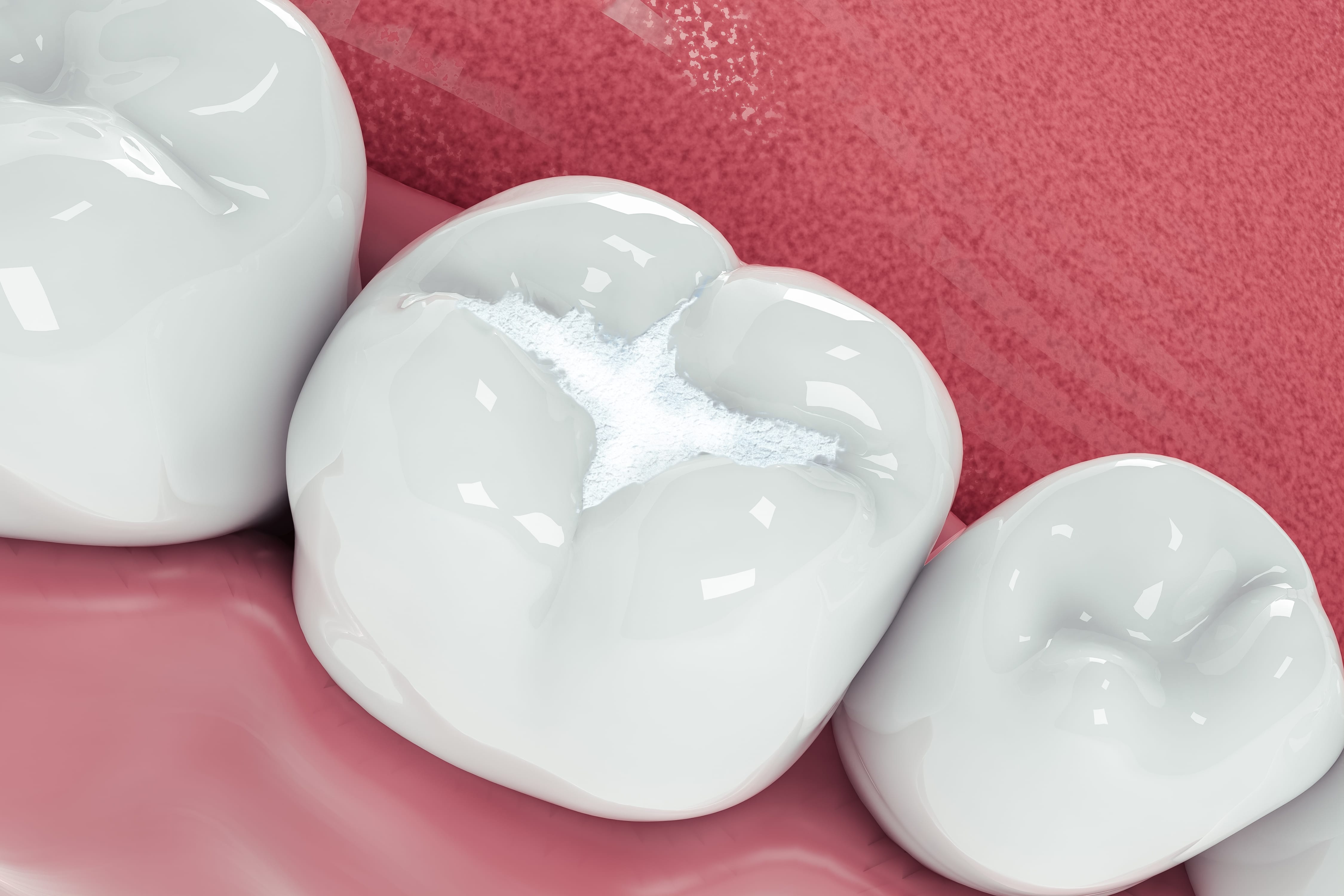 Composite Fillings and Bonding – Dentist Cape Town
