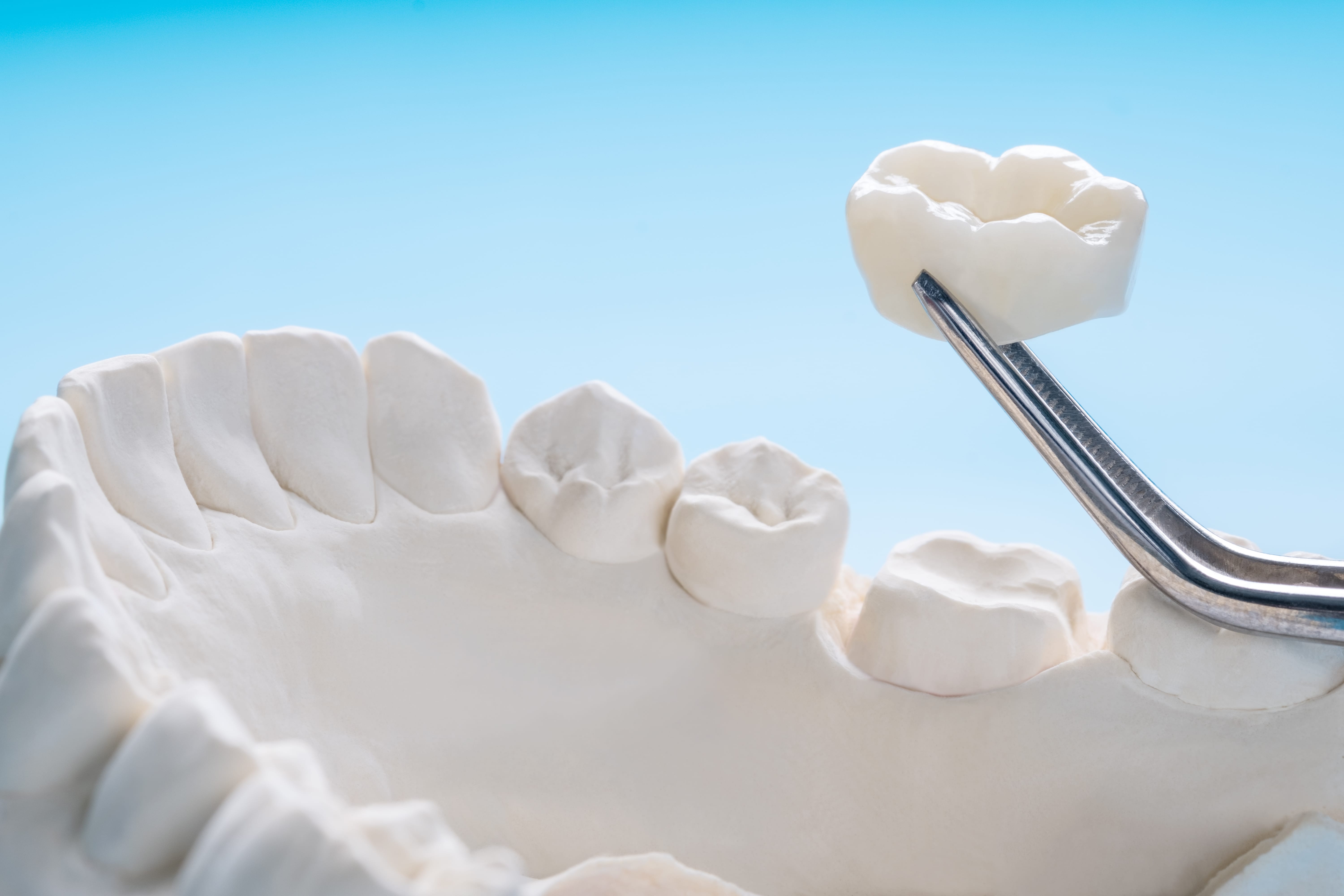 Crowns, Veneers and Bridges – Dentist Cape Town