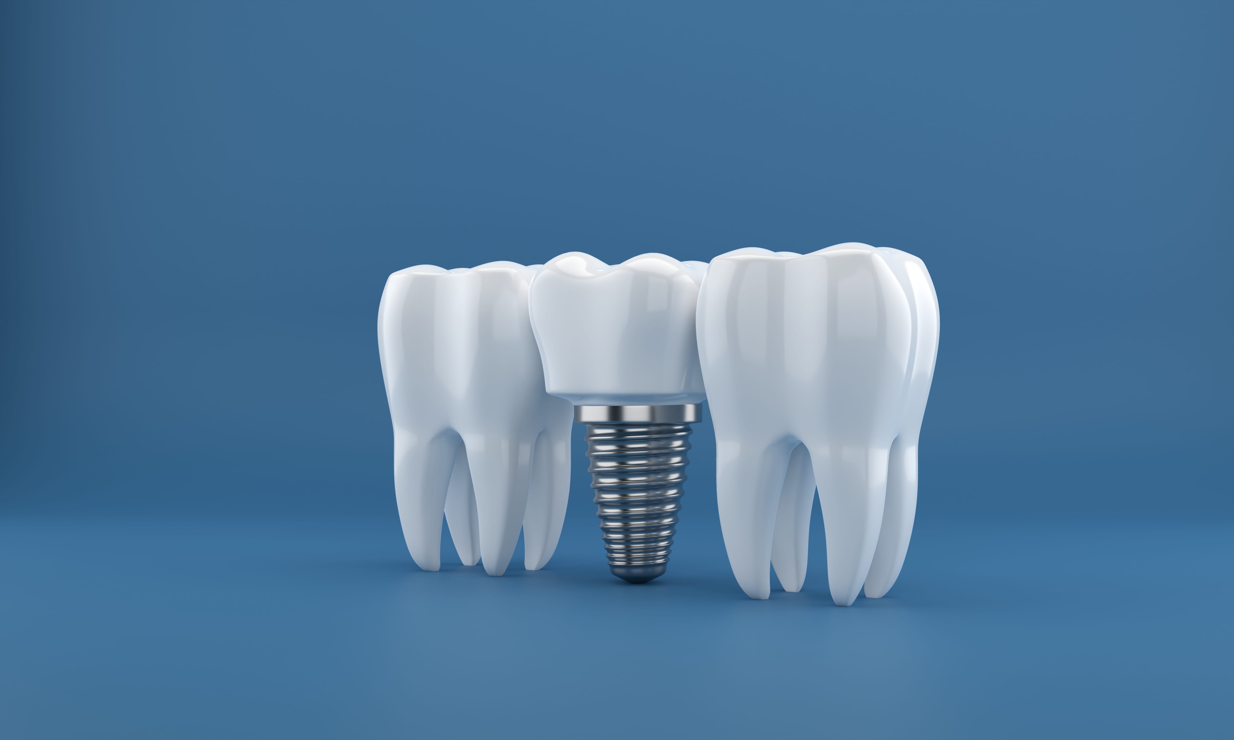 Dental Implants – Dentist Cape Town